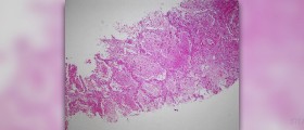 Acute proctitis facts