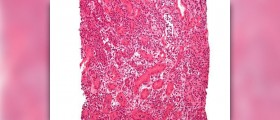 Acute pulmonary oedema