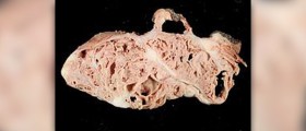 Acute renal failure causes
