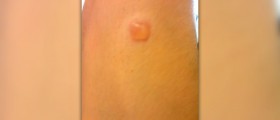 Acute sarcoidosis treatment