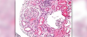 Acute soft tissue injury