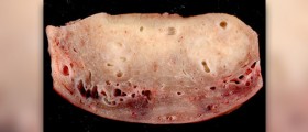 What is adenomyosis?