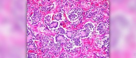 Adrenal gland cancer