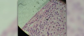 Adrenal gland surgery for tumors