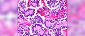 Adrenal gland tumor