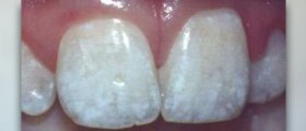 Advanced restorative techniques