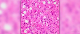 Alcoholic fatty liver