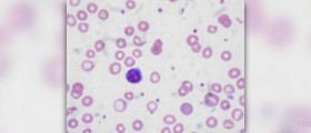 All about anemia