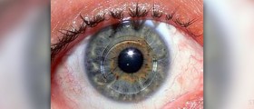 All about keratoconus