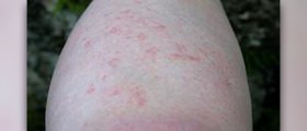 Allergic reaction to sunscreen