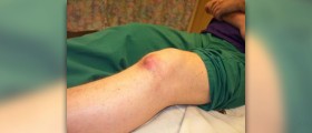 Allopurinol for gout treatment