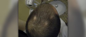 Alopecia areata causes