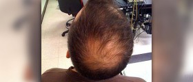 Alopecia areata treatment