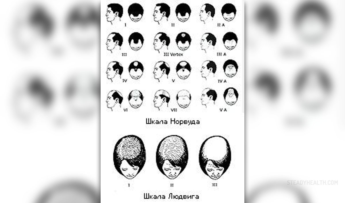 alopecia universalis regrowth signs