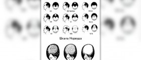 Alopecia hair loss treatment
