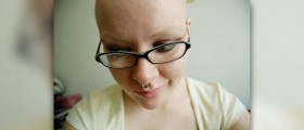 Alopecia in women