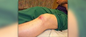 Alternative therapy for gout