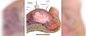 Amniocentesis - what are the risks?