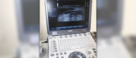 Amniocentesis for prenatal diagnosis