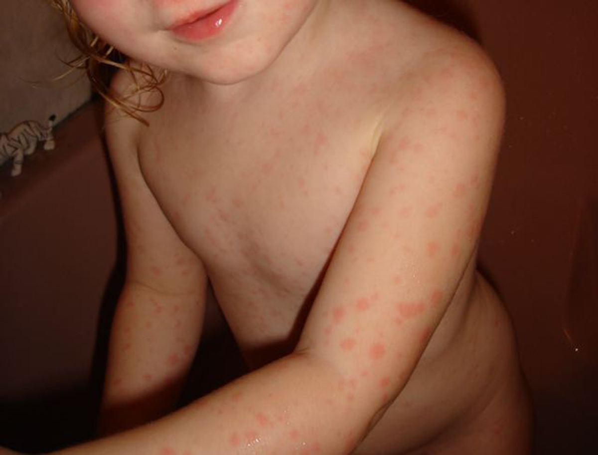 Amoxicillin Rash: Signs & Treatment for Amoxicillin Rash