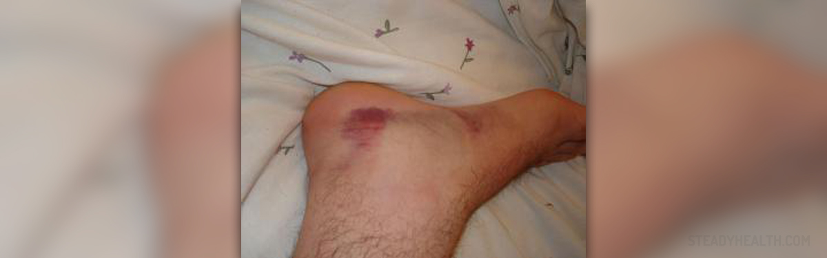 Ankle bone spurs | General center | SteadyHealth.com
