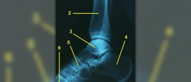 Ankle tendonitis review