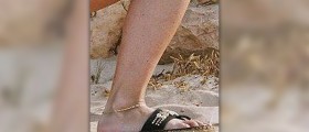 Ankles hurt after running