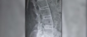Ankylosing spondylitis treatments