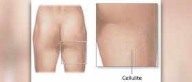 Anti cellulite machines