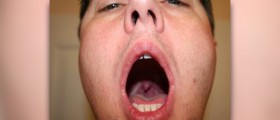Antibiotics for strep throat
