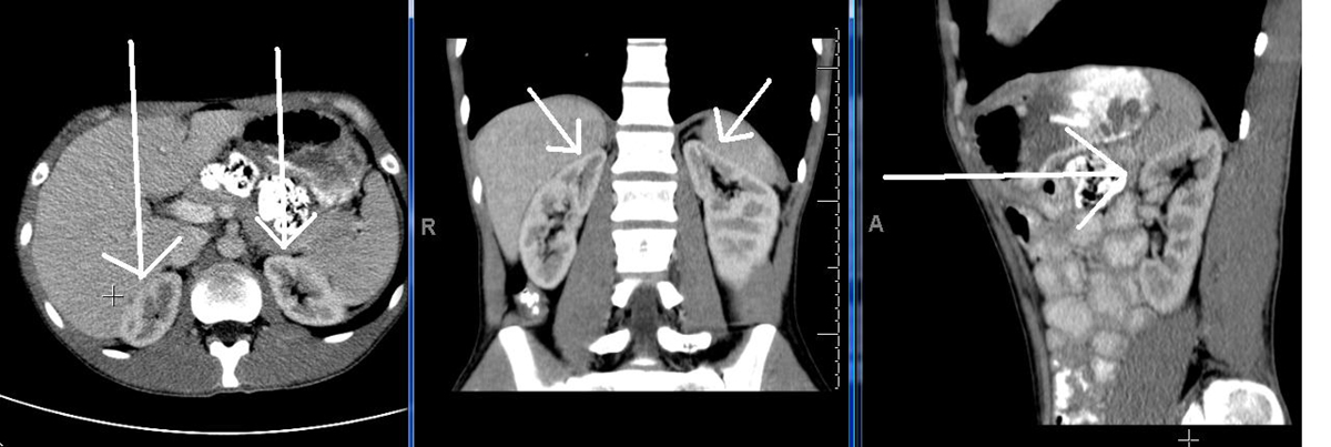 anxiety and adrenal gland