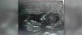 Anxiety during first trimester