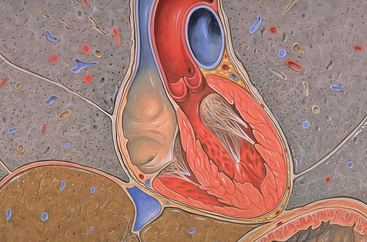 What Is Moderate Aortic Calcification