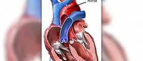 Aortic valve replacement