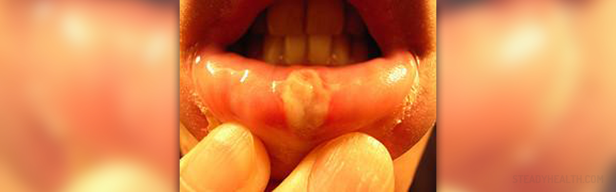 Aphthous ulcers - Canker sores | Ear, Nose, Throat, and Dental problems