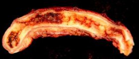 Appendicitis pain review