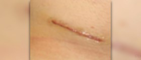 Appendicitis recovery after surgery