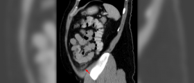 Appendicitis symptoms - signs of appendicitis