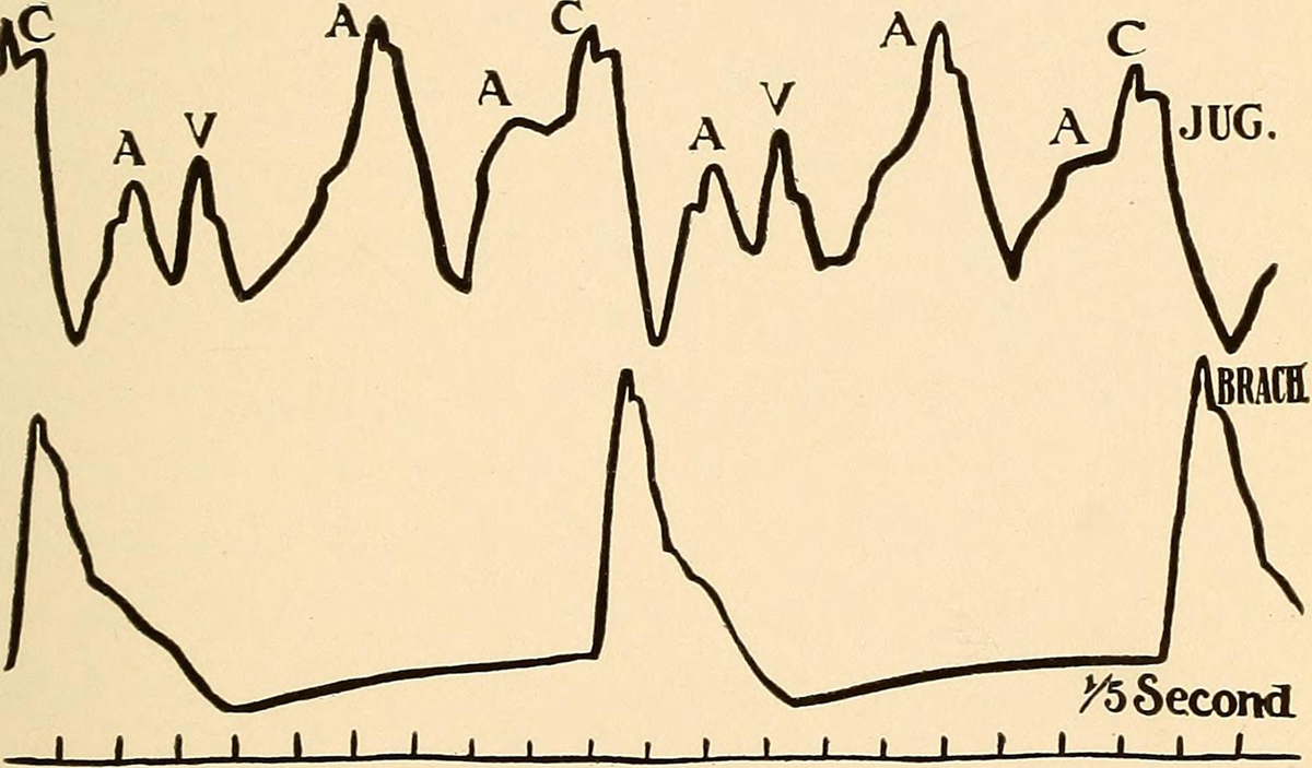 irregular heartbeat and dizziness