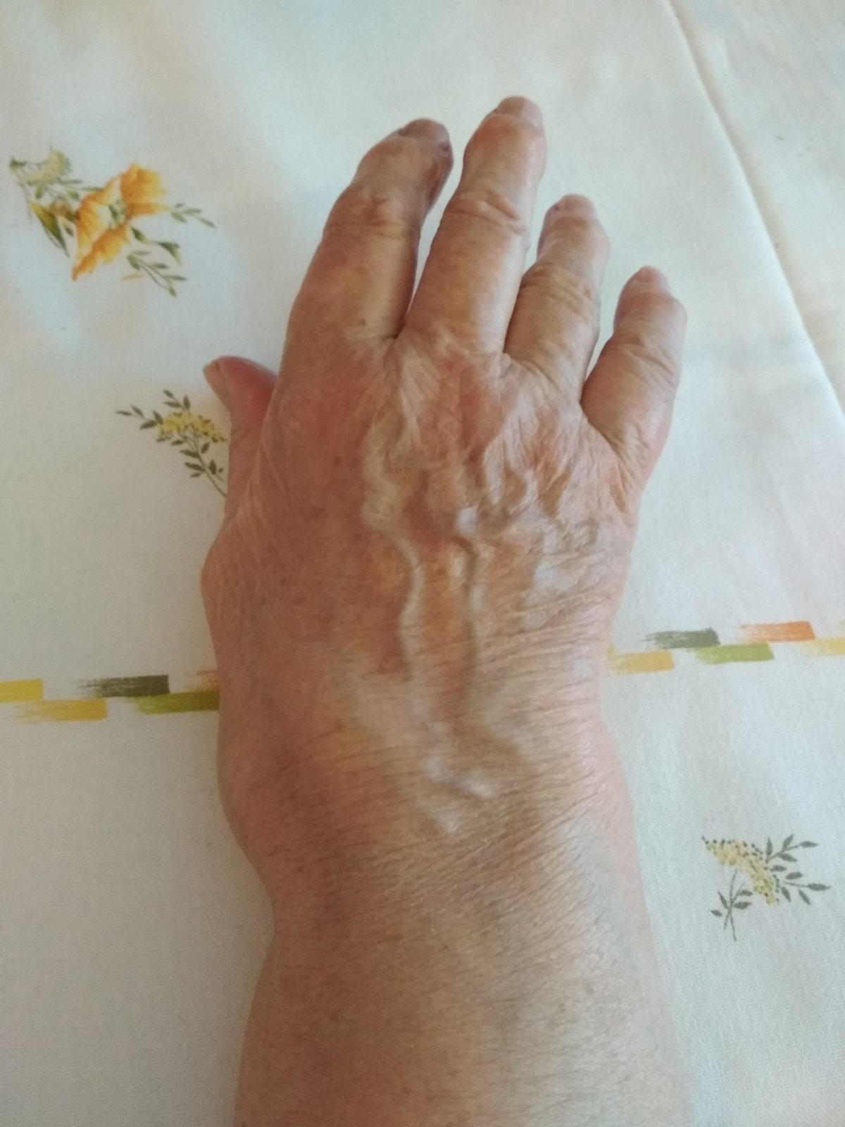 symptoms-of-wrist-arthritis-general-center-steadyhealth