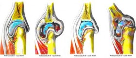 Arthroscopic knee surgery recovery