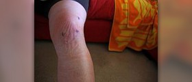 Arthroscopic knee surgery