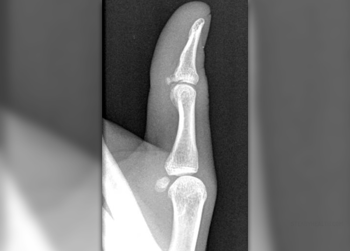 Small Avulsion Fracture