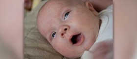 Baby acne- a common newborn condition
