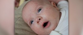 Baby acne treatment