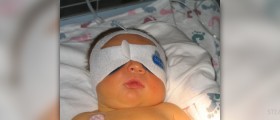 Newborn jaundice