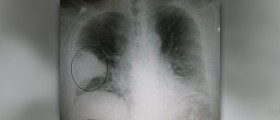 Bacterial pneumonia in children