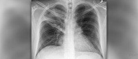 Bacterial pneumonia review