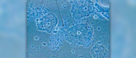 What is bacterial vaginosis?