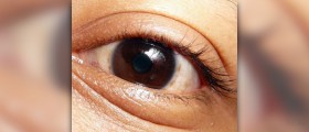 Baggy eyes treatment